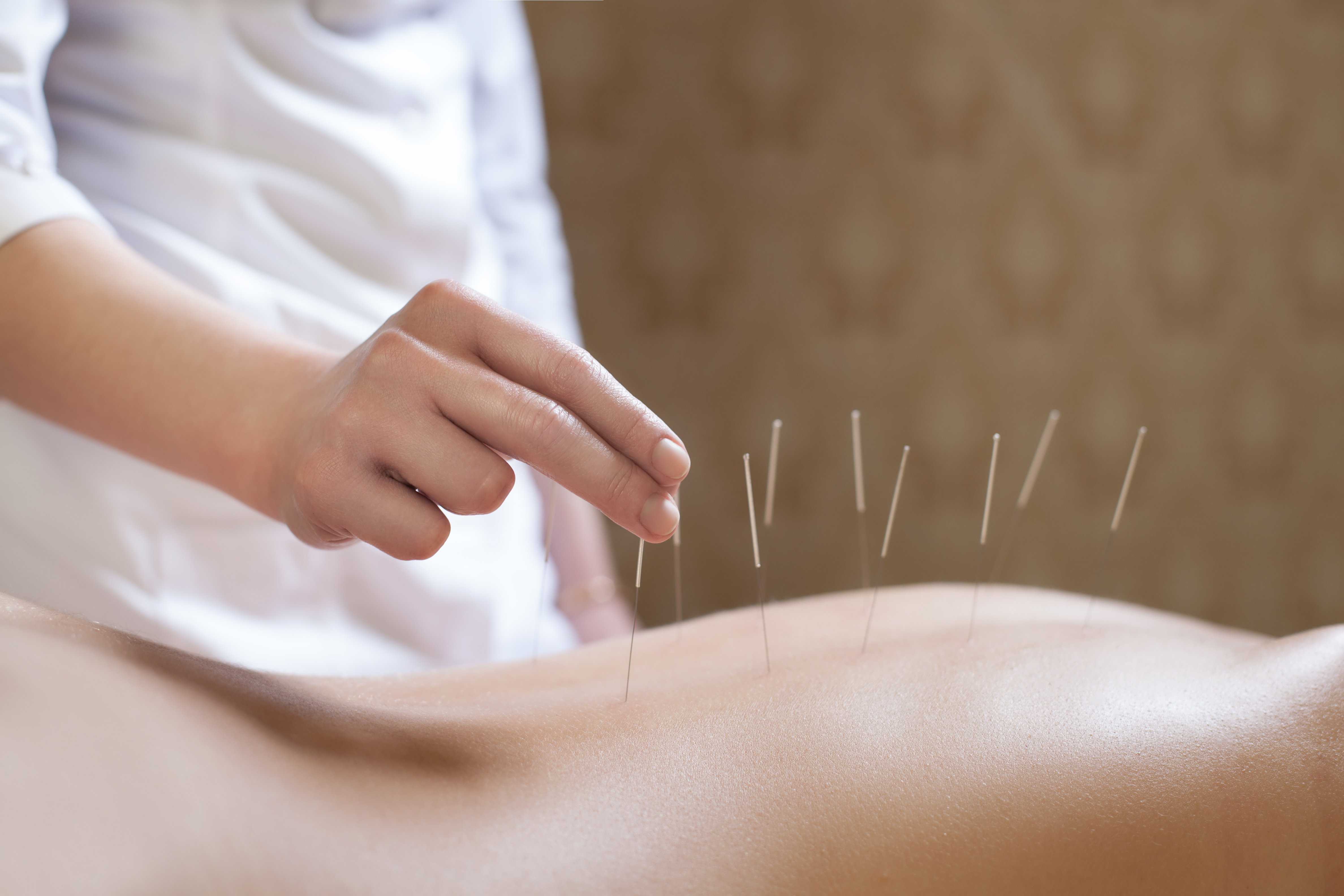 Multiple Precisely Placed Acupuncture Needles on Upper Back Region