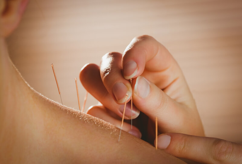 Acupuncture - Trigger Point Therapy / Dry Needling